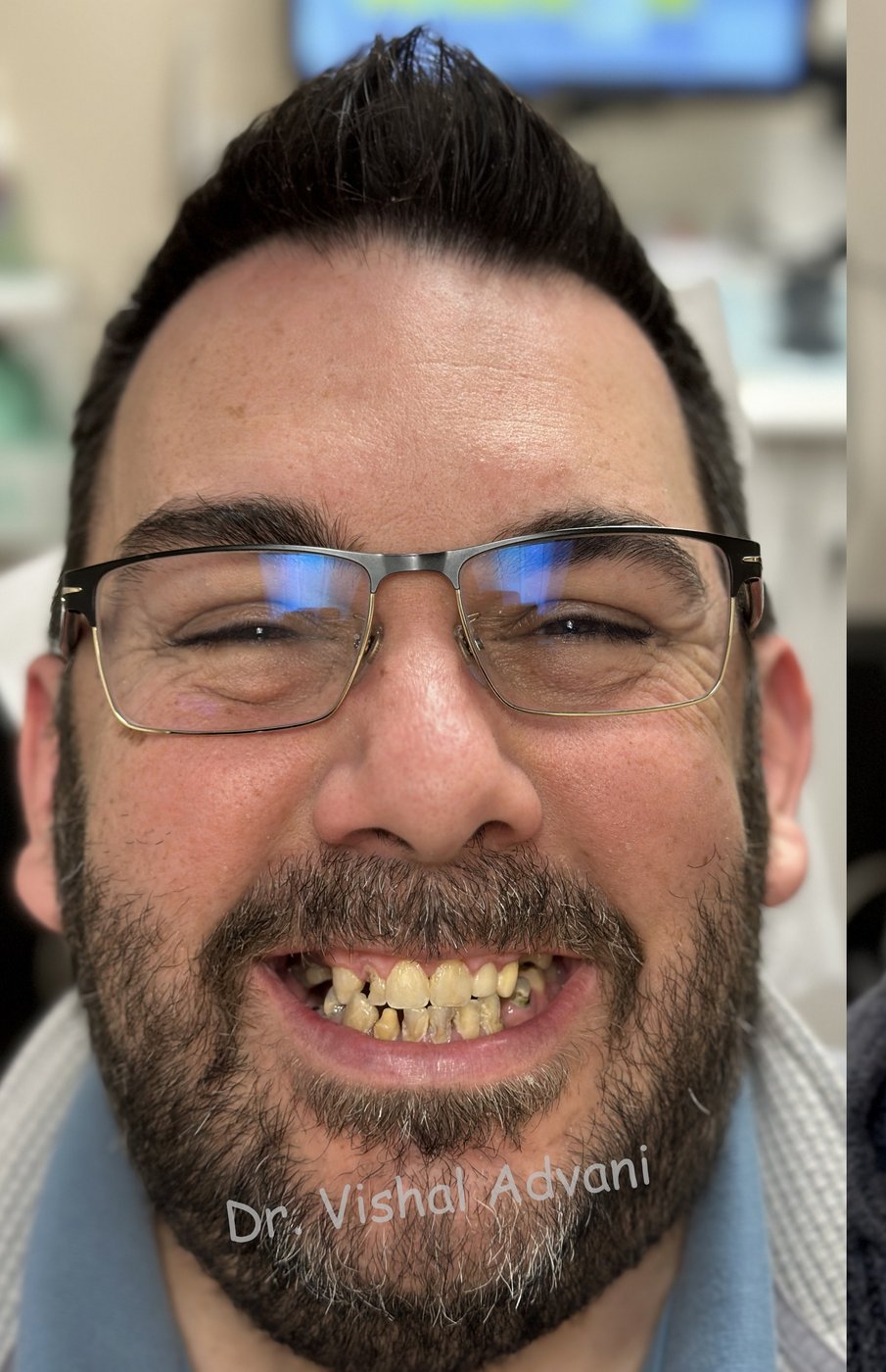Patient before full-arch dental implant treatment