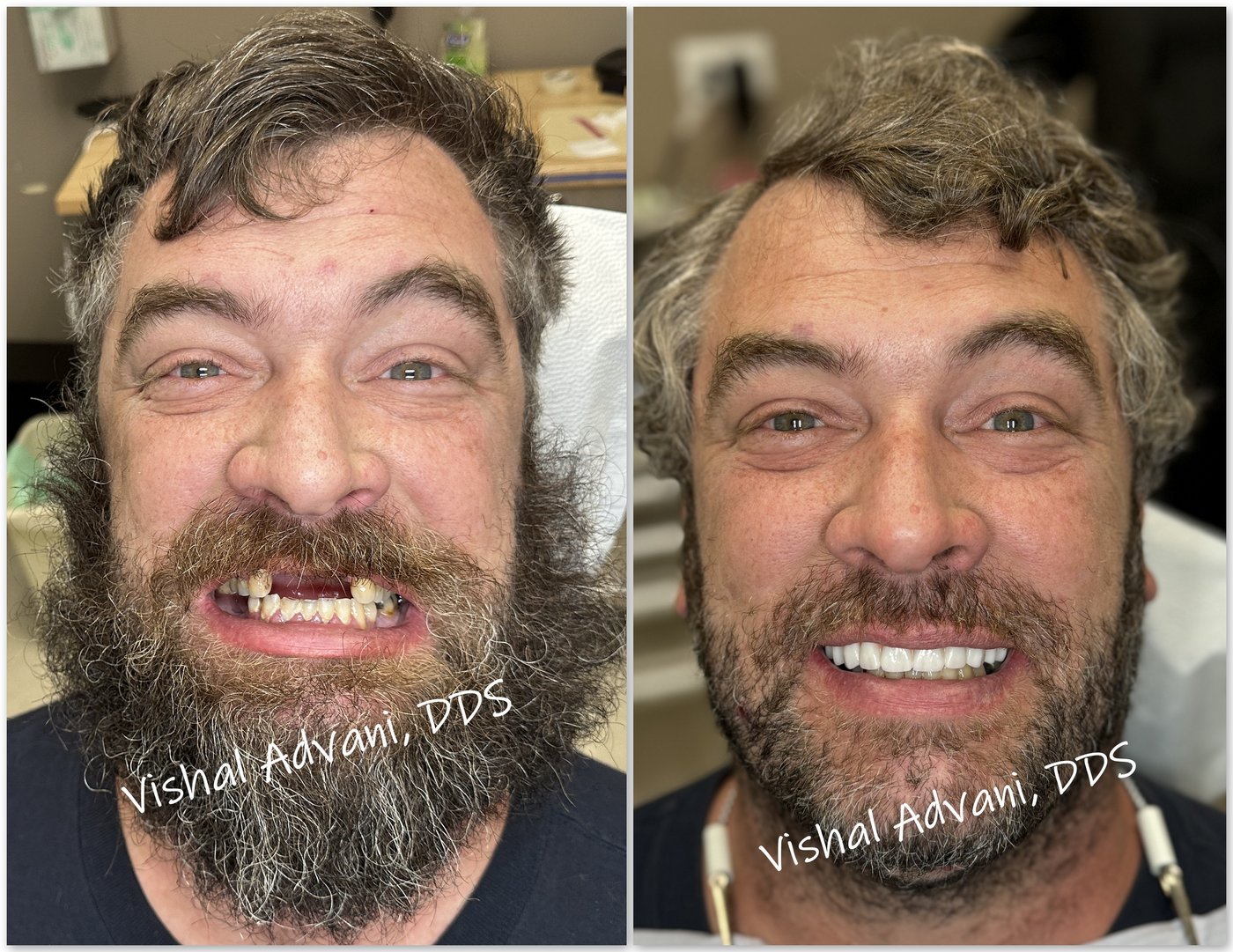 Patient before and after full-arch dental implants