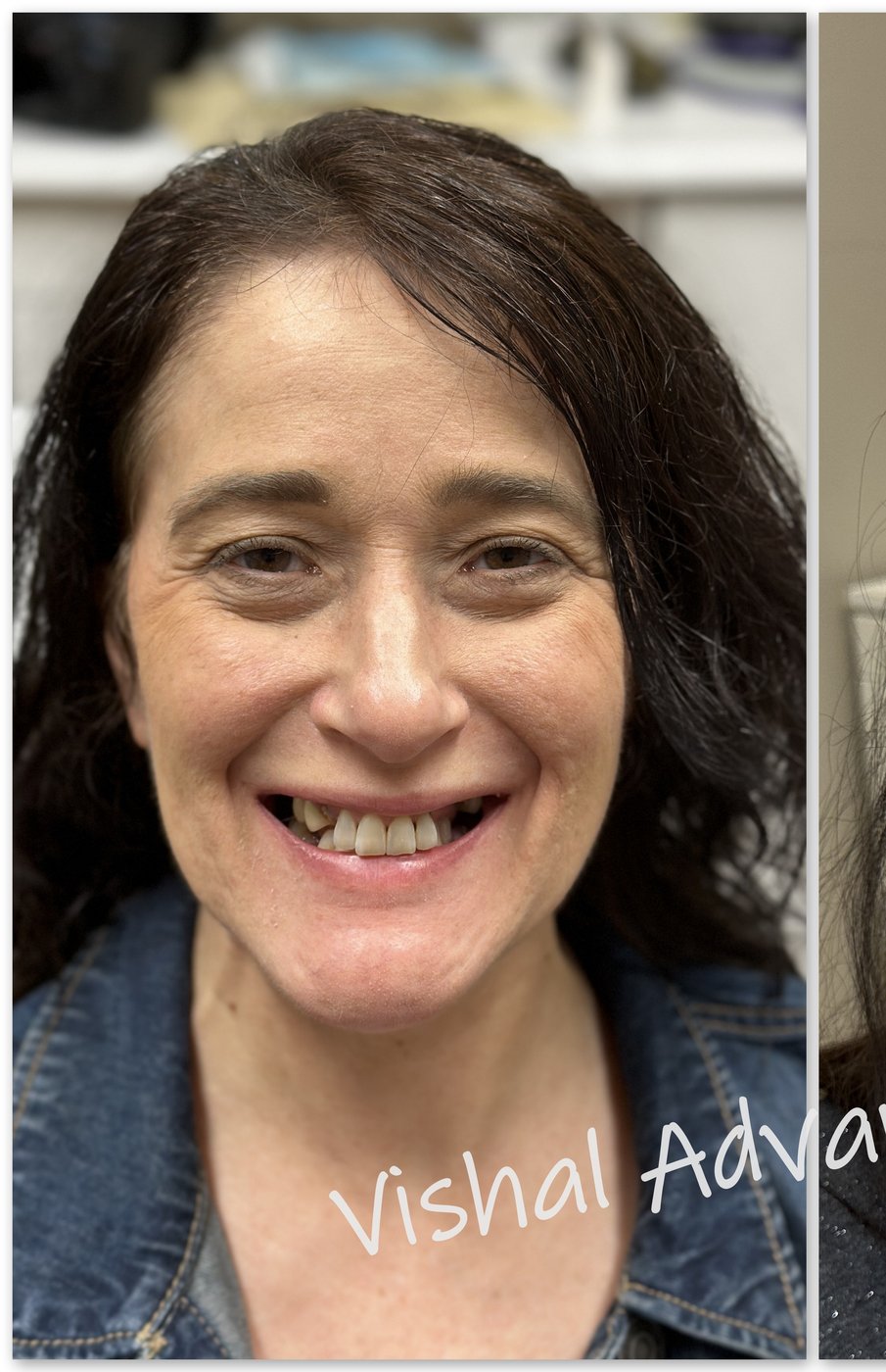 Patient before dental implant treatment