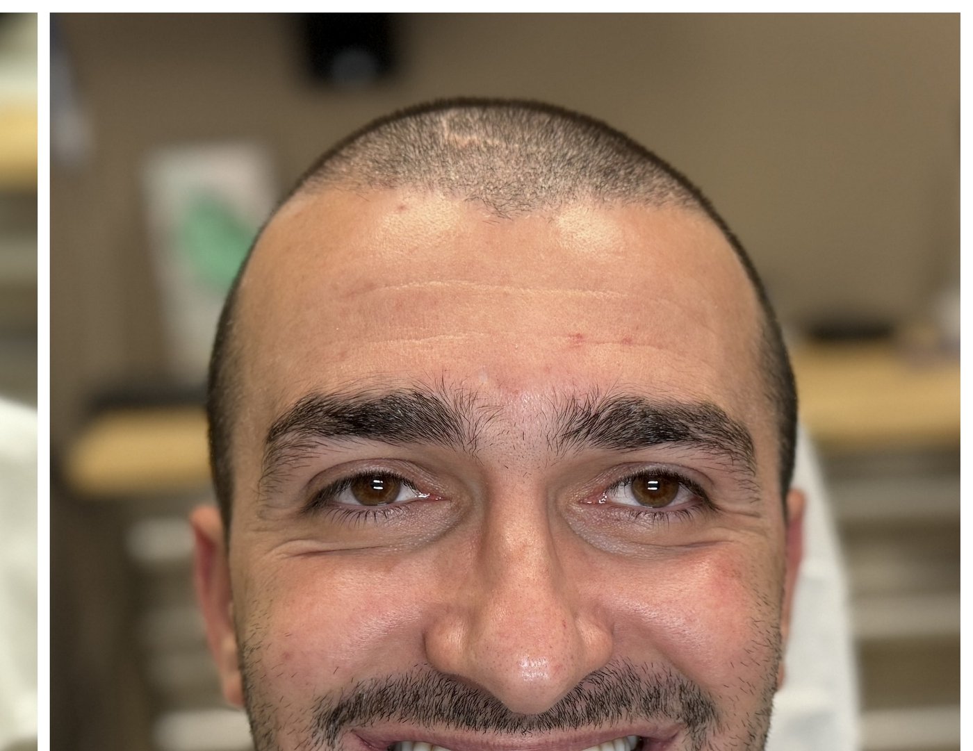 Patient after full-mouth dental implant reconstruction