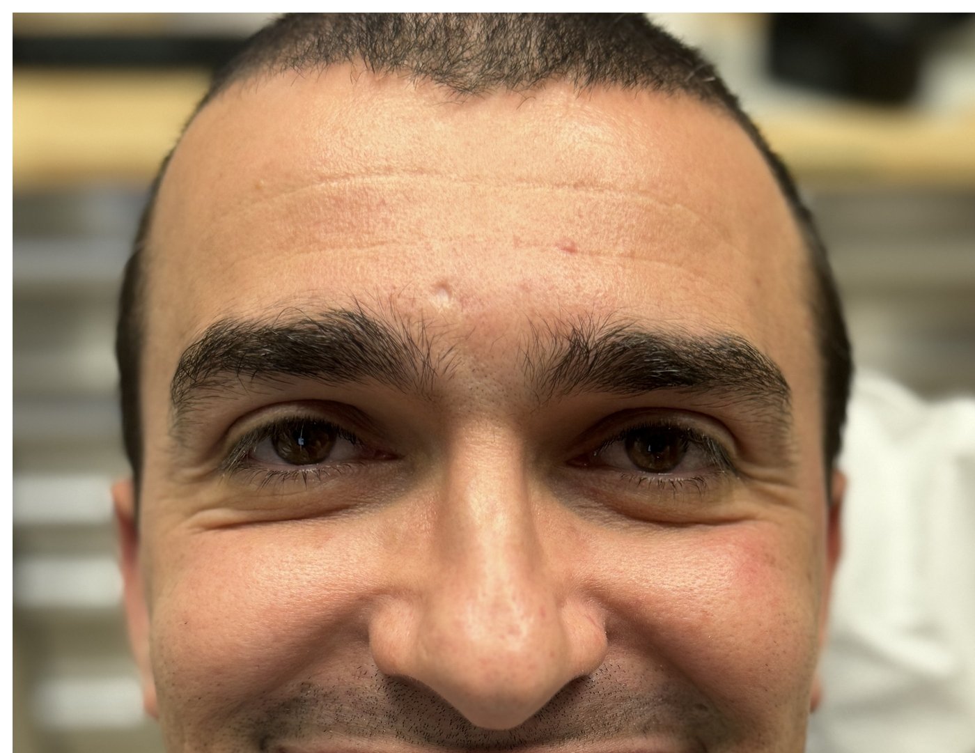 Patient before dental implant treatment