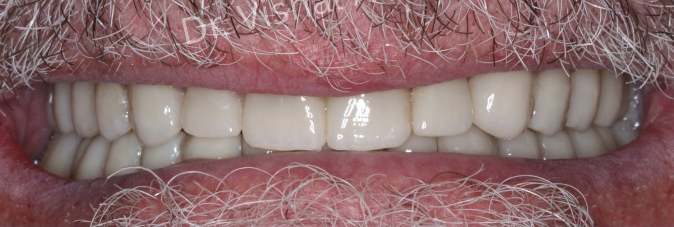 Close-up after full-arch dental implants
