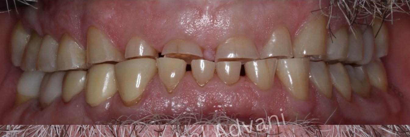 Close-up before full-arch dental implants