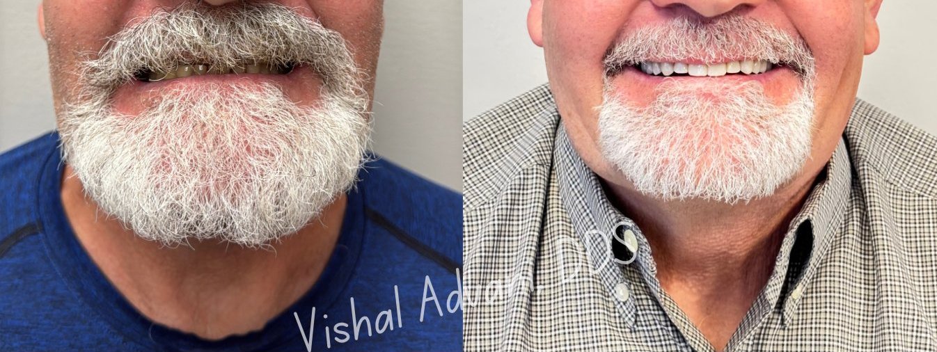 Anterior immediate restoration result