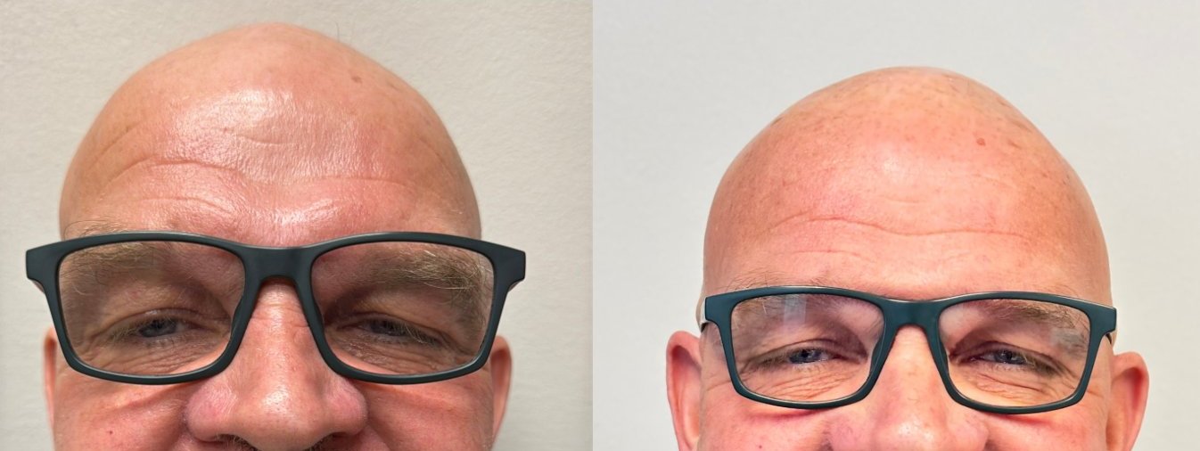 Close-up before dental implant treatment