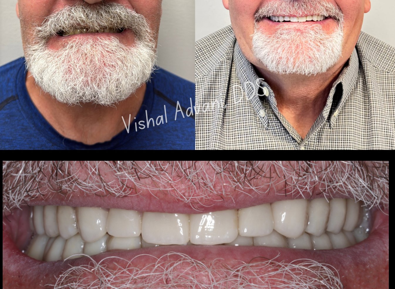 Anterior immediate implant — final result