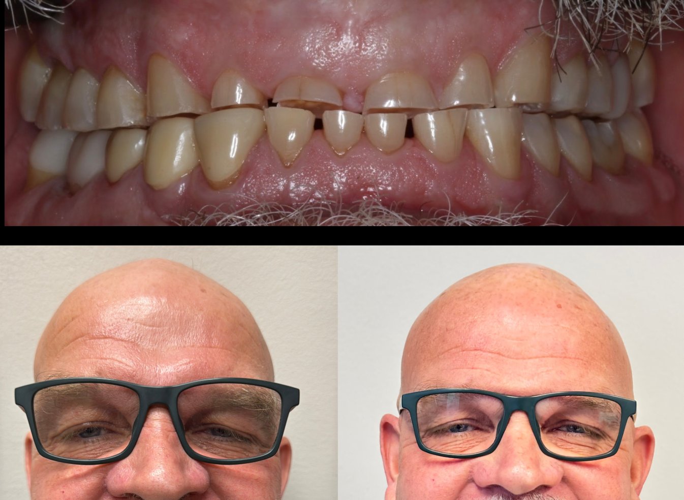 Close-up before full-mouth dental implants