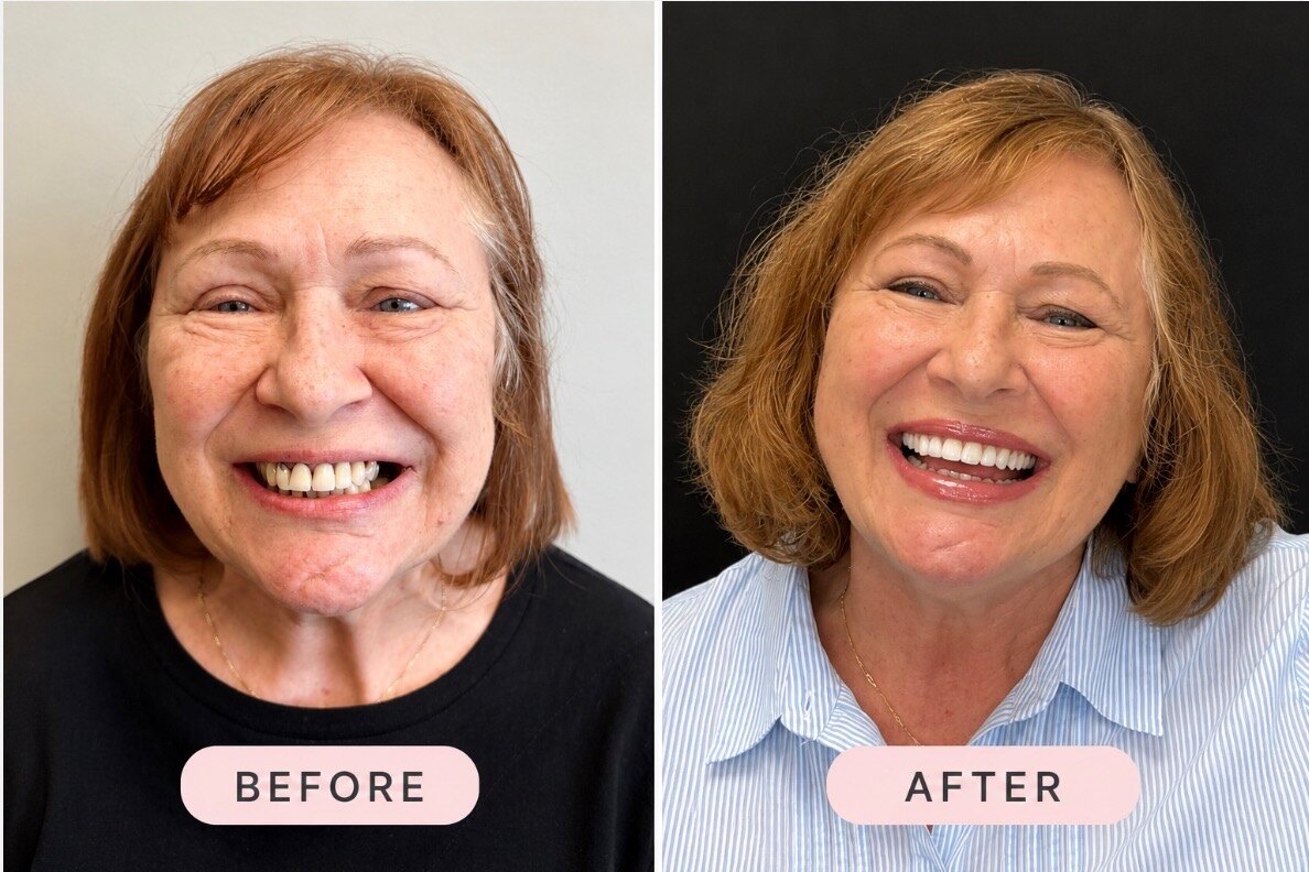 Anna before and after
