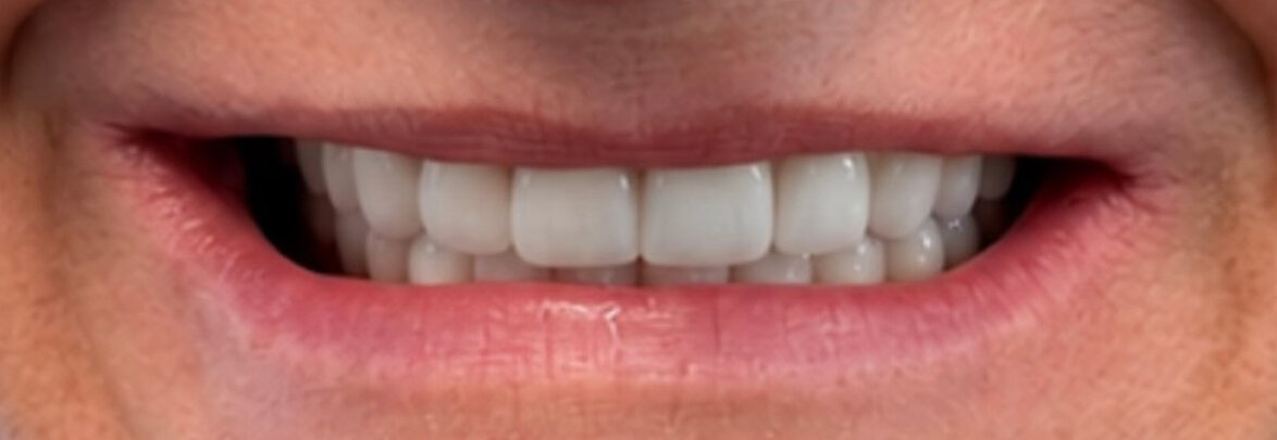 Close-up after: Dominika's upper and lower zirconia implant bridges