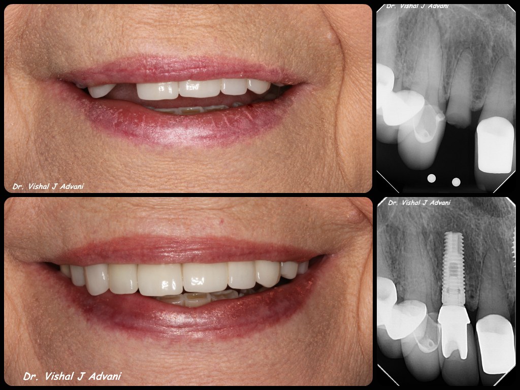 Immediate Implant · Same-Day Temporary · 10-Year Follow-Up — before and after dental implant treatment