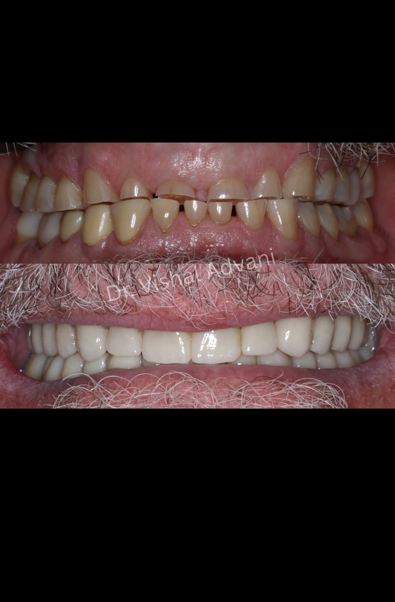 Worn Dentition Rehabilitation — before and after dental implant treatment