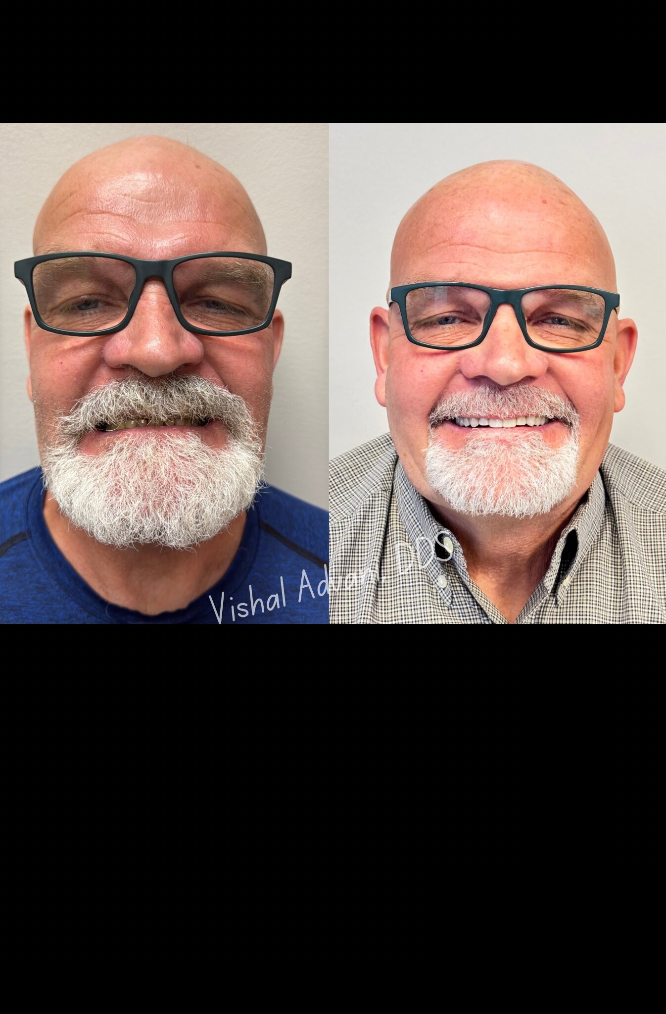 Smile Restoration · Renewed Confidence — before and after dental implant treatment
