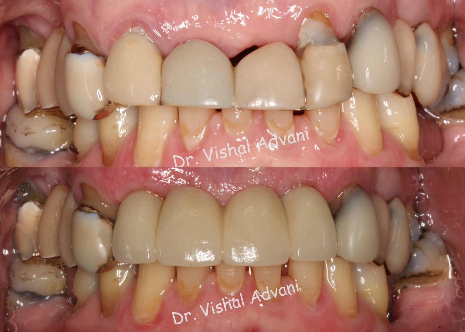 Front Bridge Replacement · 2 Implants Supporting a 4-Unit Bridge — before and after dental implant treatment