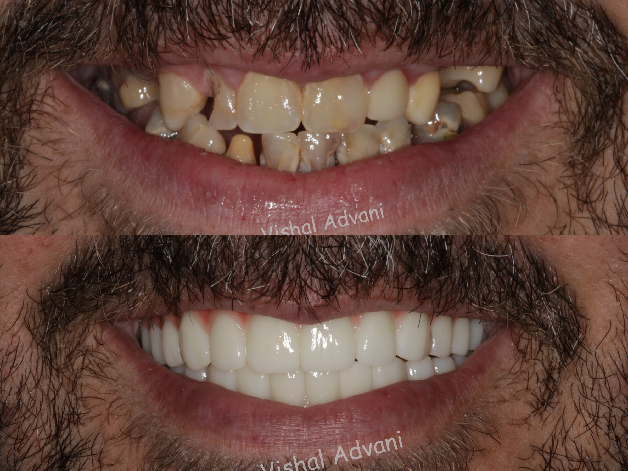 Full-arch implant restoration before and after