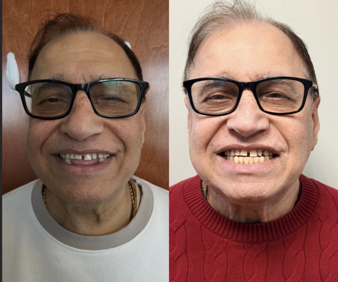 Lower Anterior Implant Bridge — before and after dental implant treatment