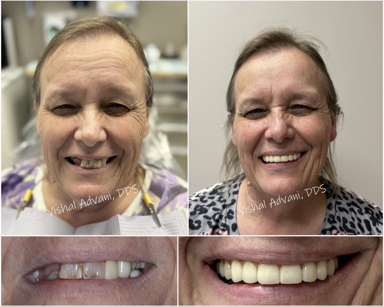 Full-Arch Upper Implant Rehabilitation · Retreatment — before and after dental implant treatment