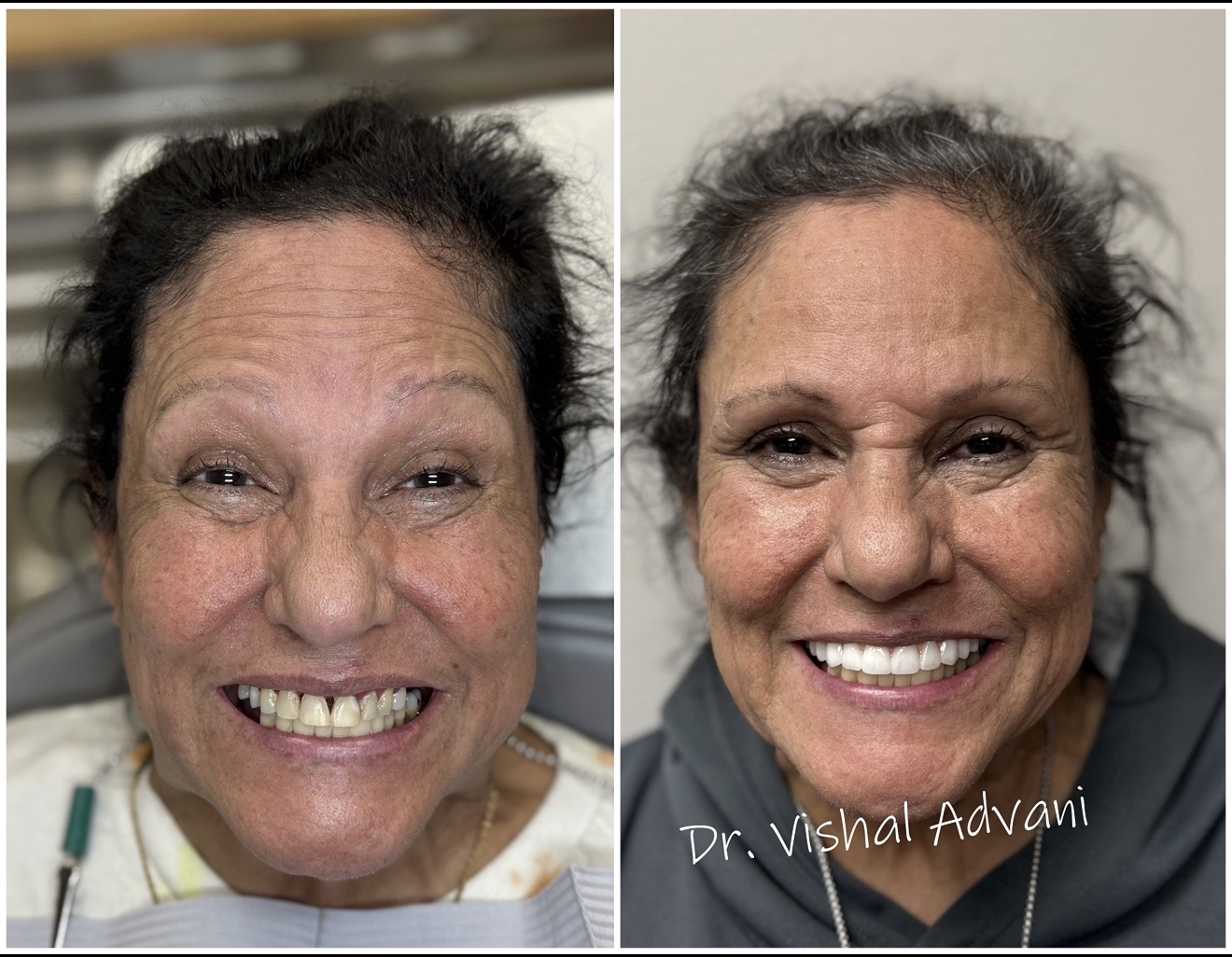 Full-Arch Upper Implants · Zirconia Bridge — before and after dental implant treatment