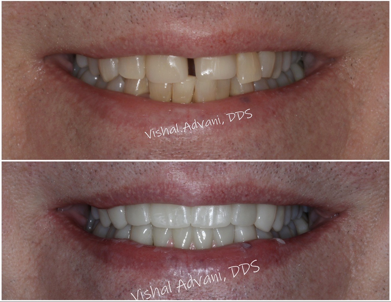 Upper and Lower Anterior Implants and Bridges — before and after dental implant treatment