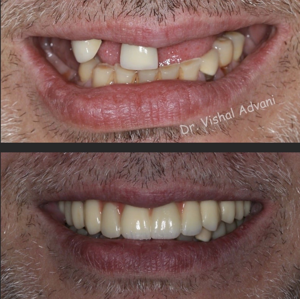 All-on-6 Upper Arch · Replacing a Failing Partial Denture — before and after dental implant treatment