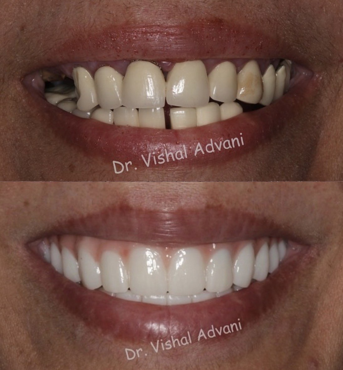 Full Upper and Lower Implants · In-Office Milled Zirconia Bridges — before and after dental implant treatment