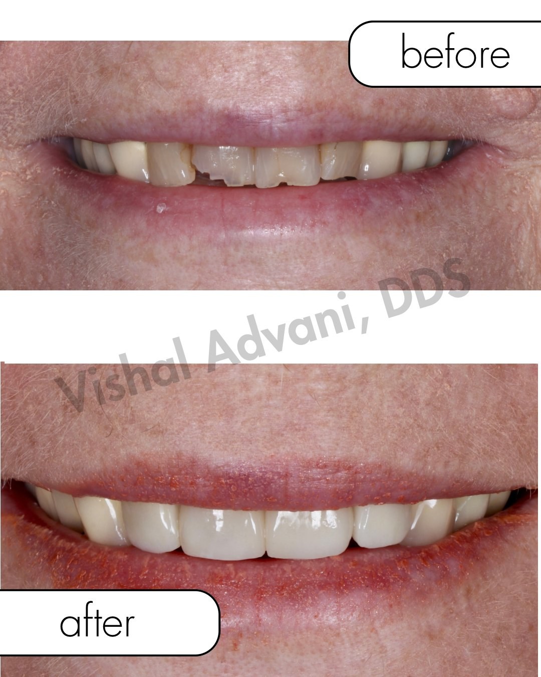 Upper Front Veneers · Smile Enhancement — before and after dental treatment