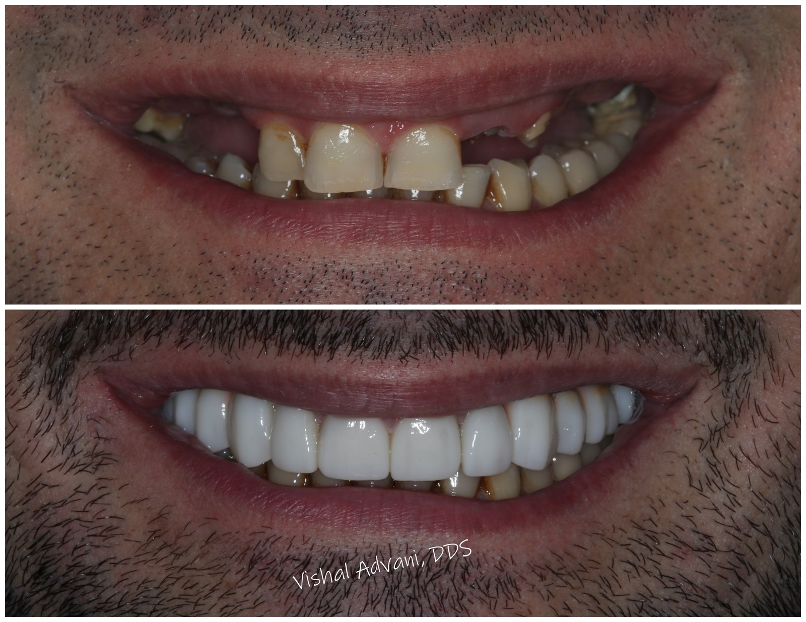 Upper Arch · Implants and Crowns · Close-Up View — before and after dental implant treatment