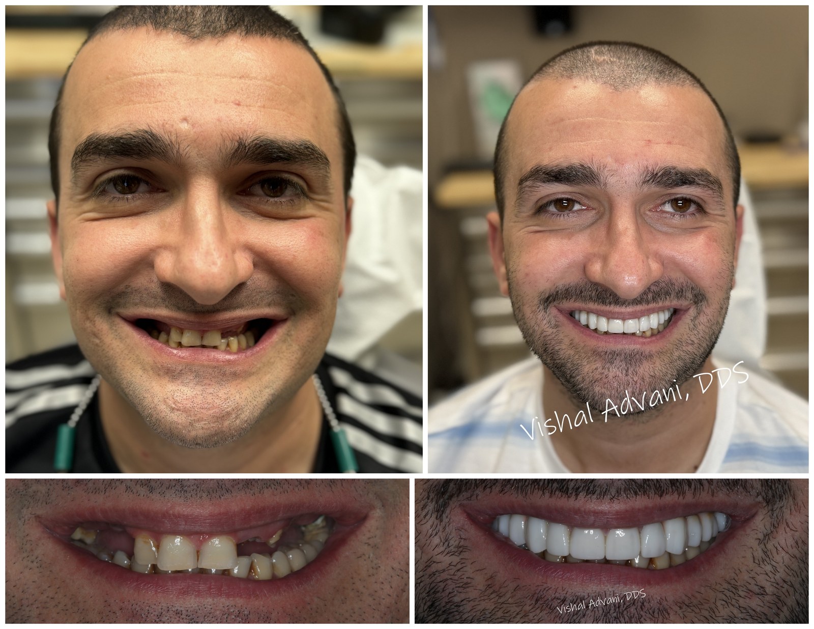 Upper arch implants and crowns before and after