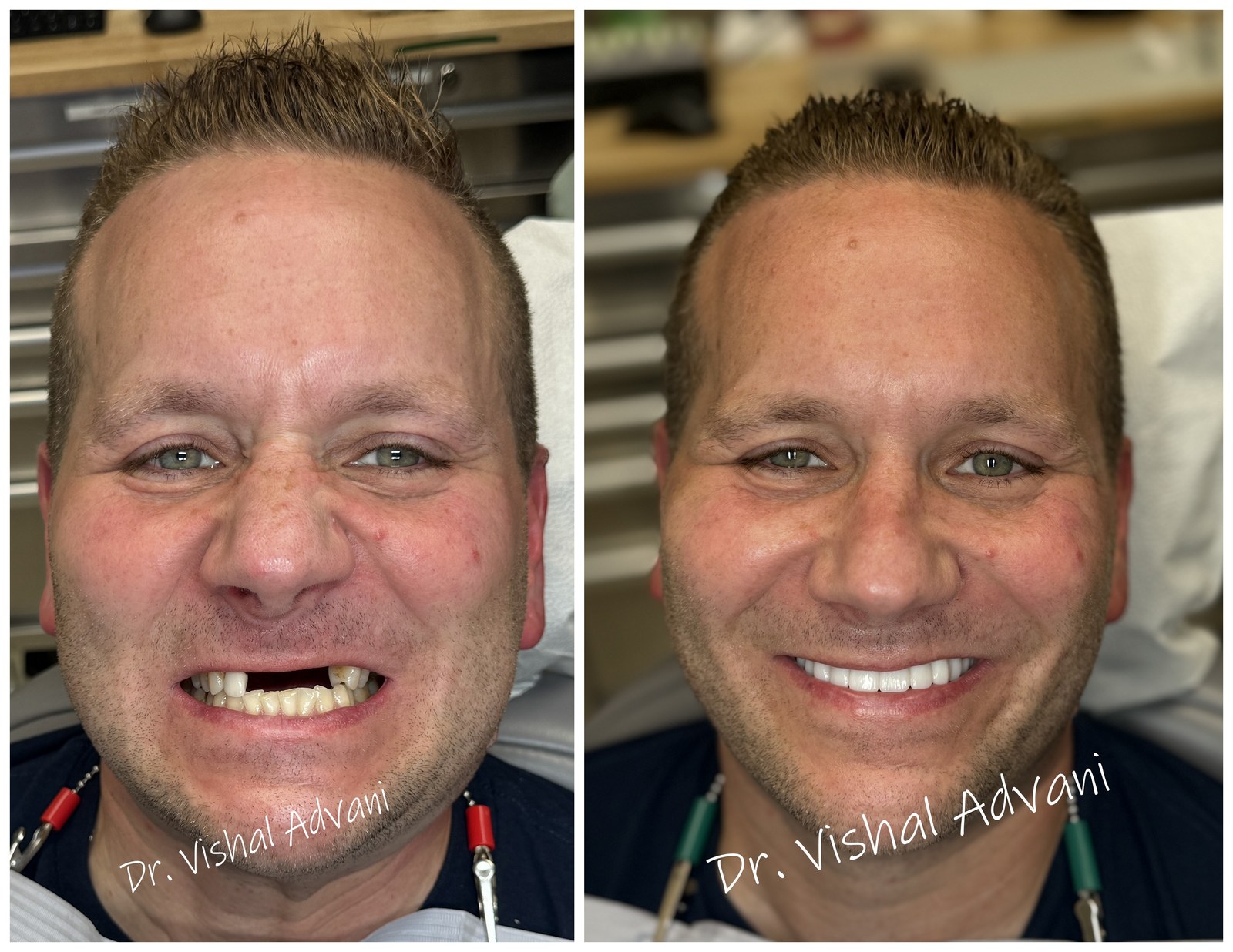 Full upper smile makeover before and after