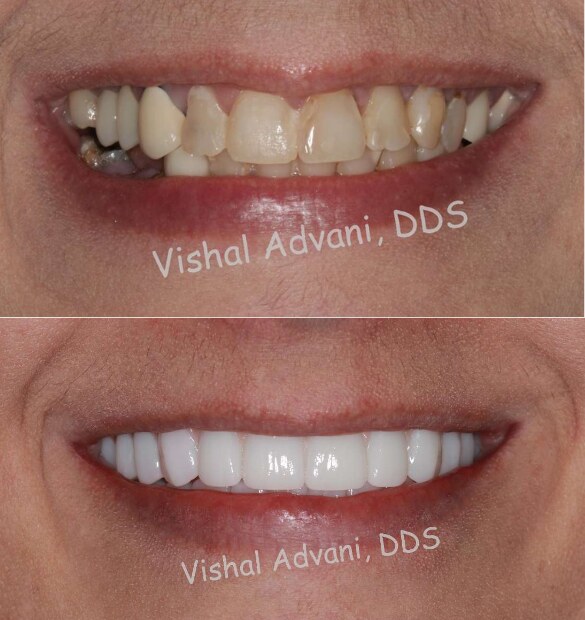 Smile close-up before and after