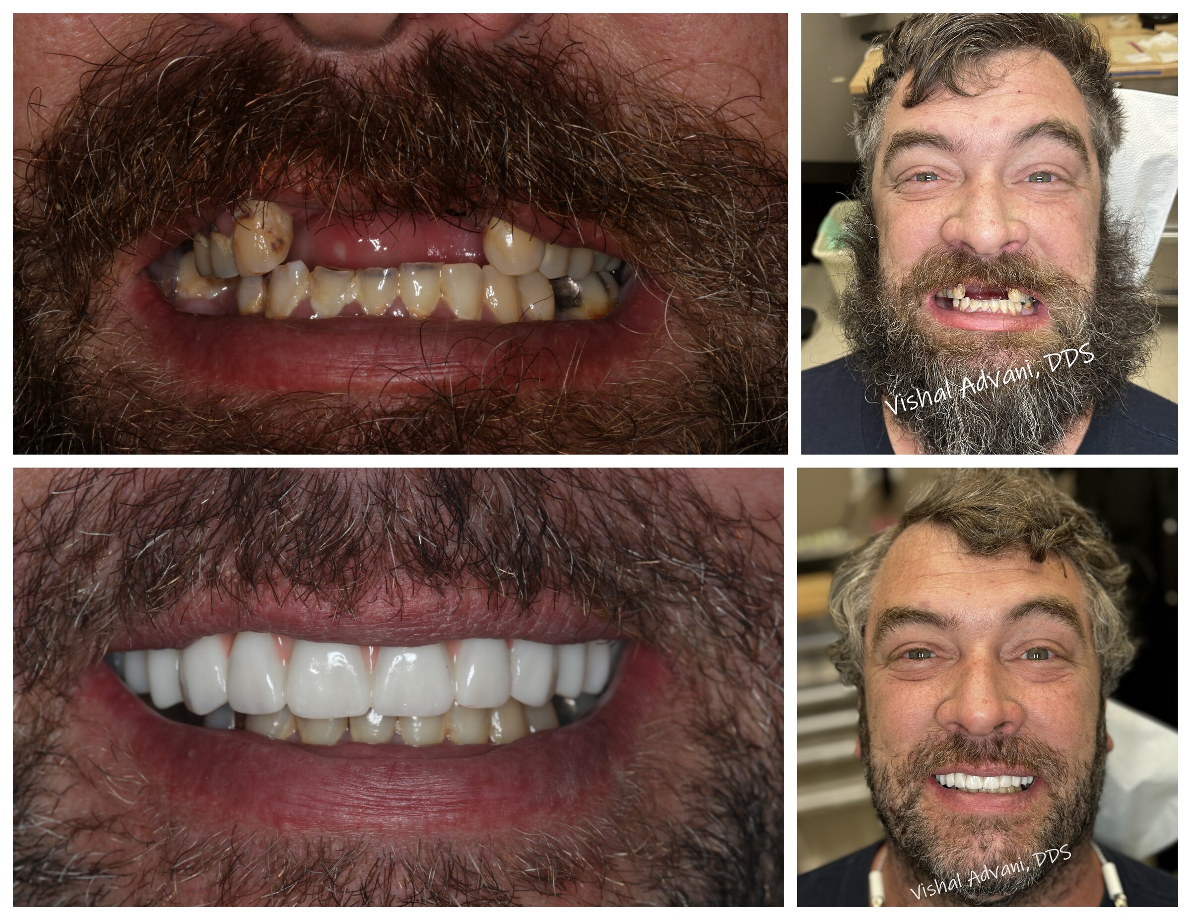 Full-Arch Upper Implants · Multi-View Documentation — before and after dental implant treatment