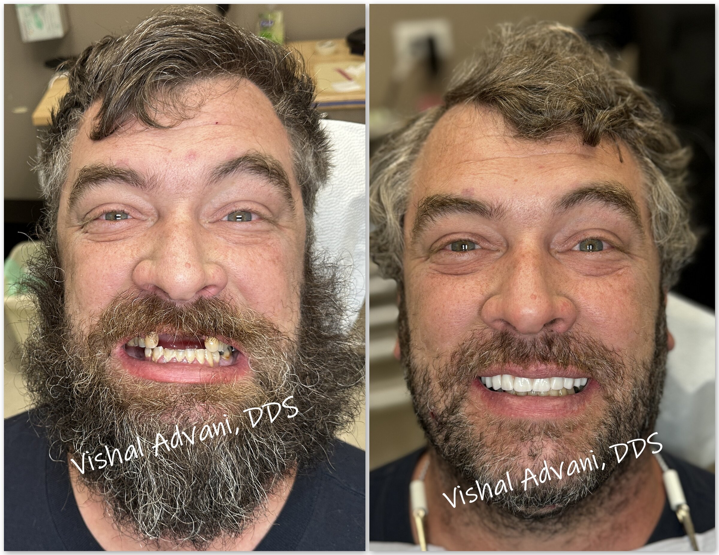 Full-Arch Upper Implants · Zirconia Bridge — before and after dental implant treatment