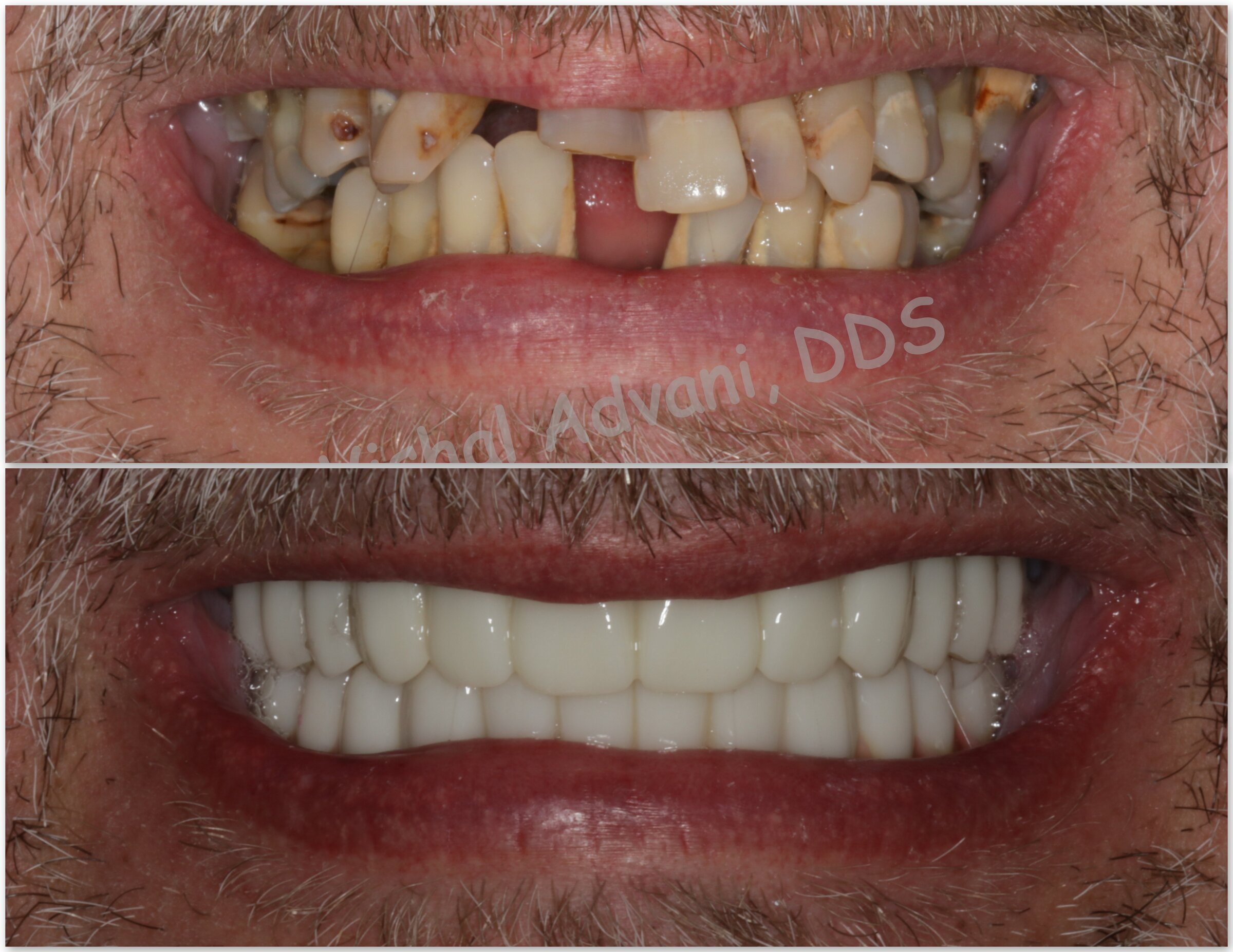 Dual-Arch Full-Mouth Implant Reconstruction — before and after dental implant treatment