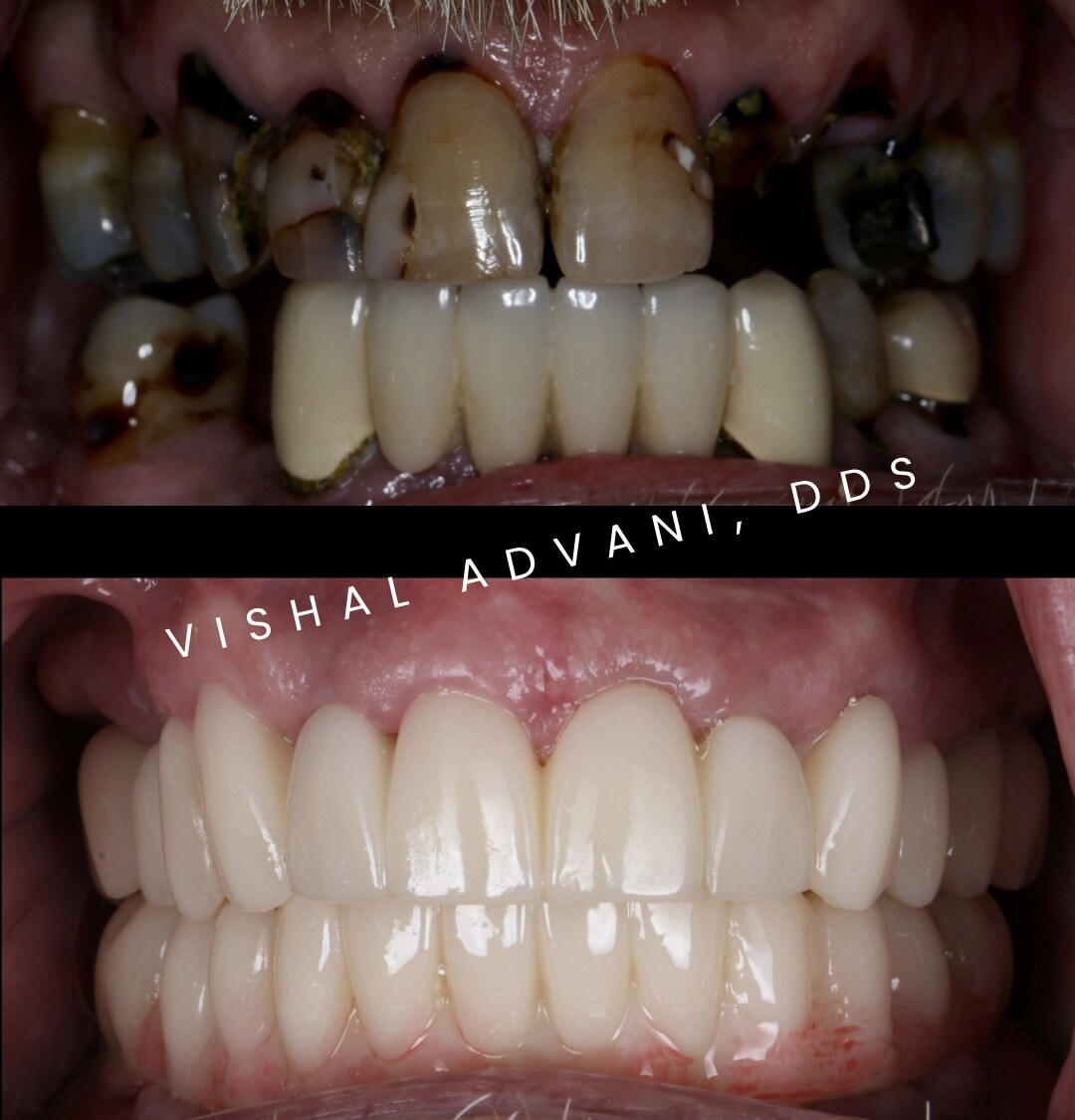 Actual patient one week after surgery — upper jaw FP1, lower jaw FP3